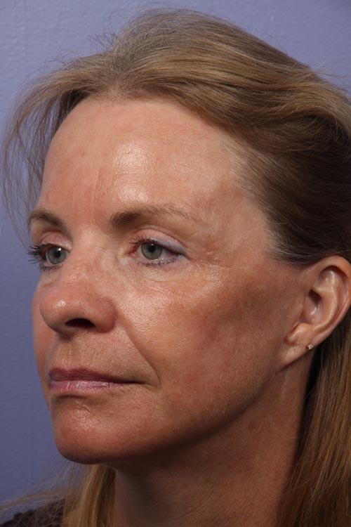 Facelift Before & After Image