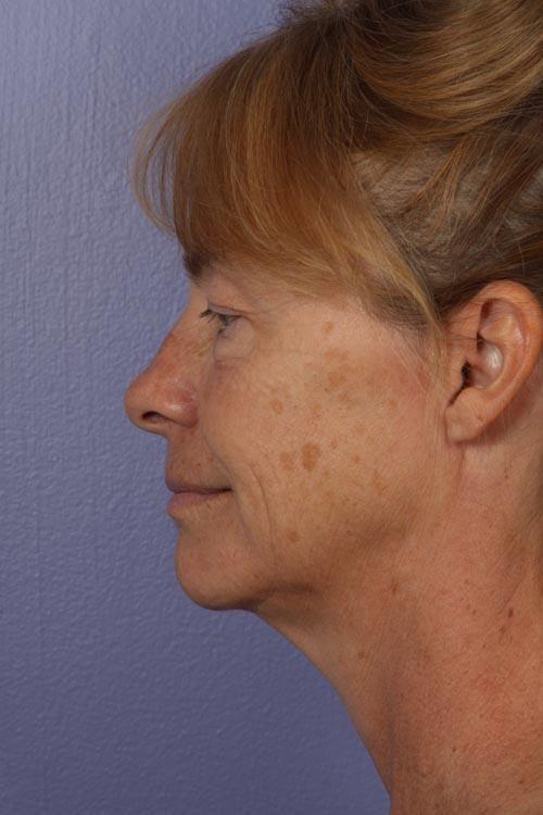 Facelift Before & After Image