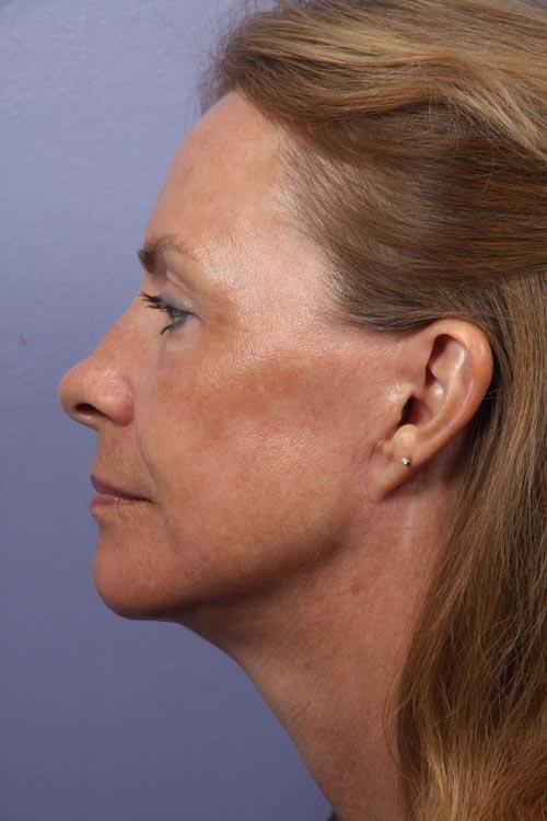 Facelift Before & After Image