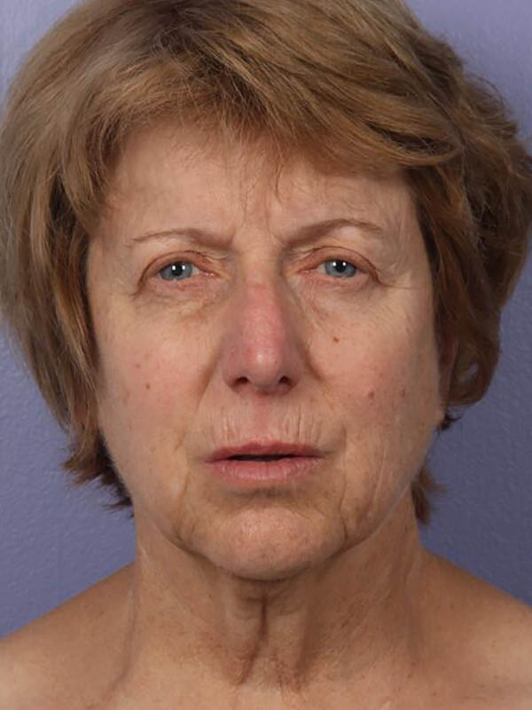 Facelift Before & After Image