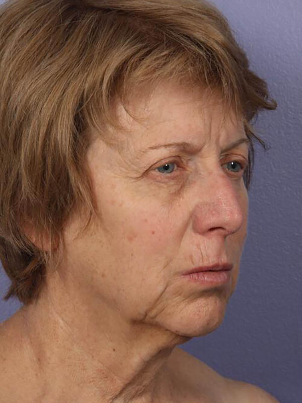 Facelift Before & After Image