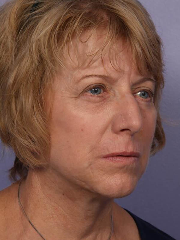 Facelift Before & After Image