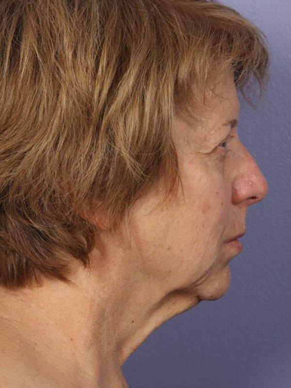 Facelift Before & After Image