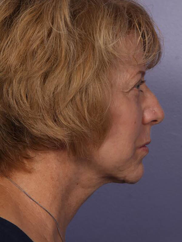 Facelift Before & After Image