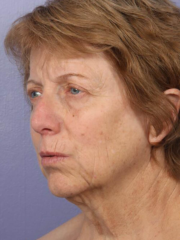 Facelift Before & After Image