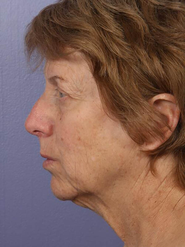 Facelift Before & After Image