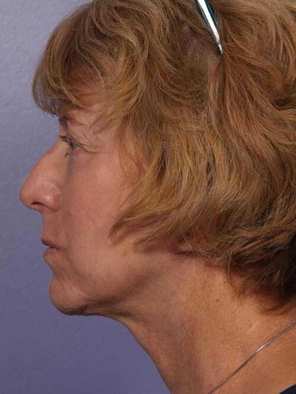 Facelift Before & After Image