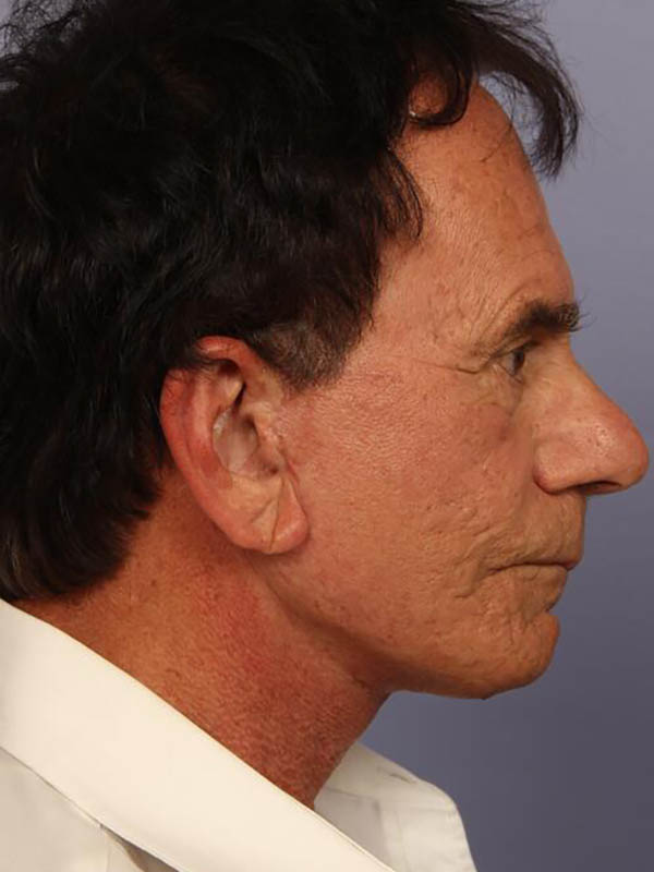 Facelift Before & After Image