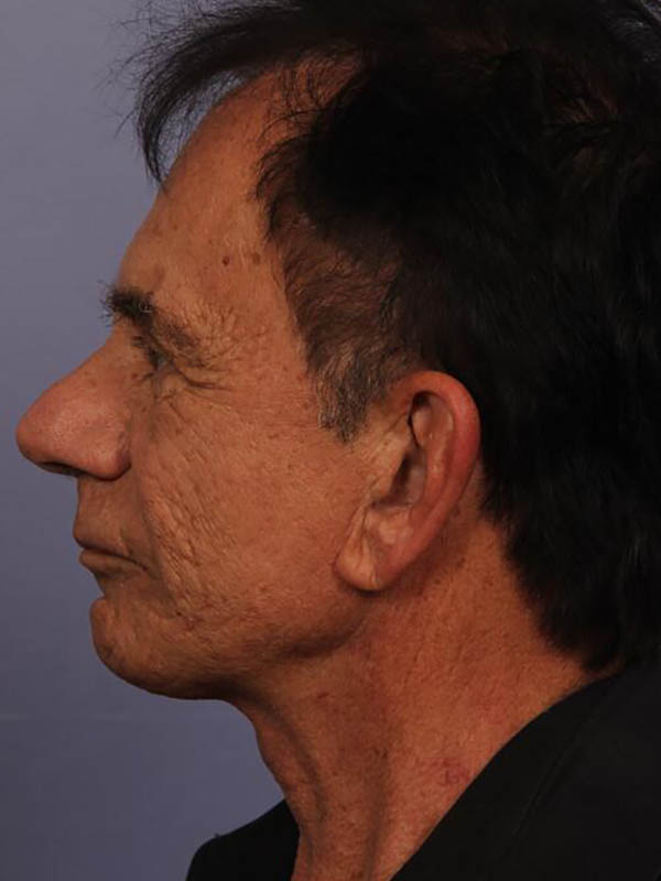 Facelift Before & After Image