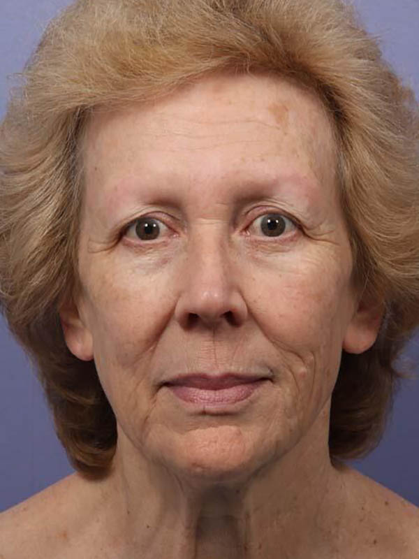 Facelift Before & After Image