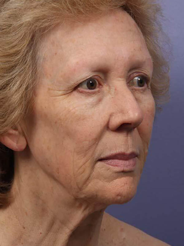 Facelift Before & After Image