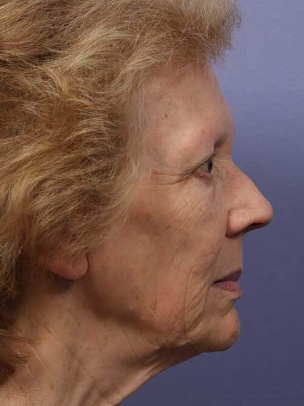 Facelift Before & After Image