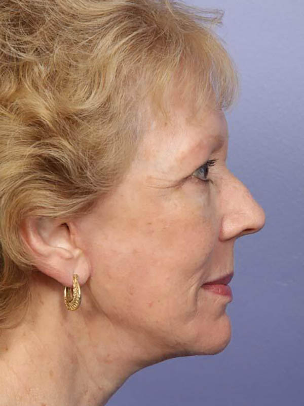 Facelift Before & After Image