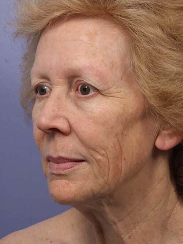 Facelift Before & After Image