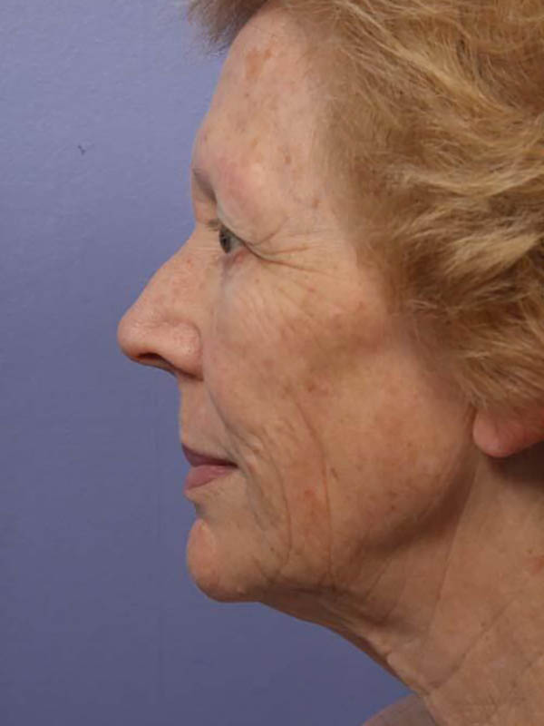 Facelift Before & After Image