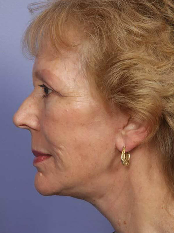 Facelift Before & After Image