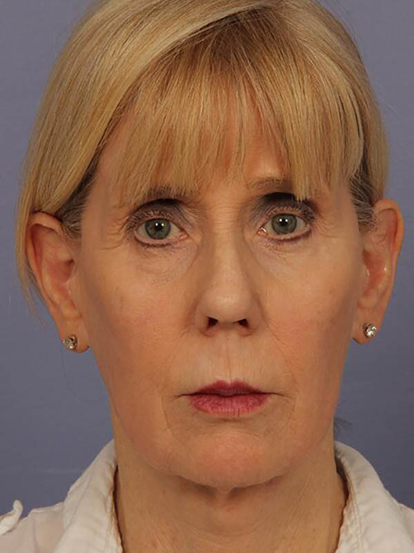 Facelift Before & After Image