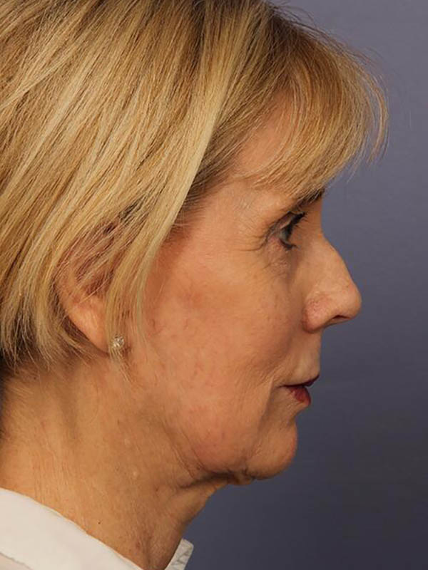 Facelift Before & After Image