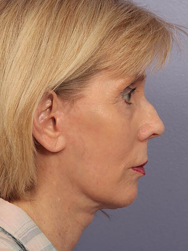 Facelift Before & After Image