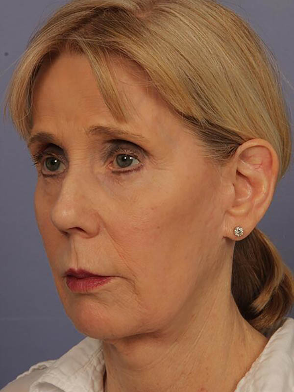 Facelift Before & After Image