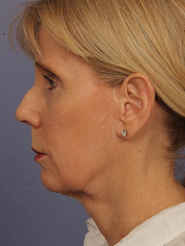 Facelift Before & After Image