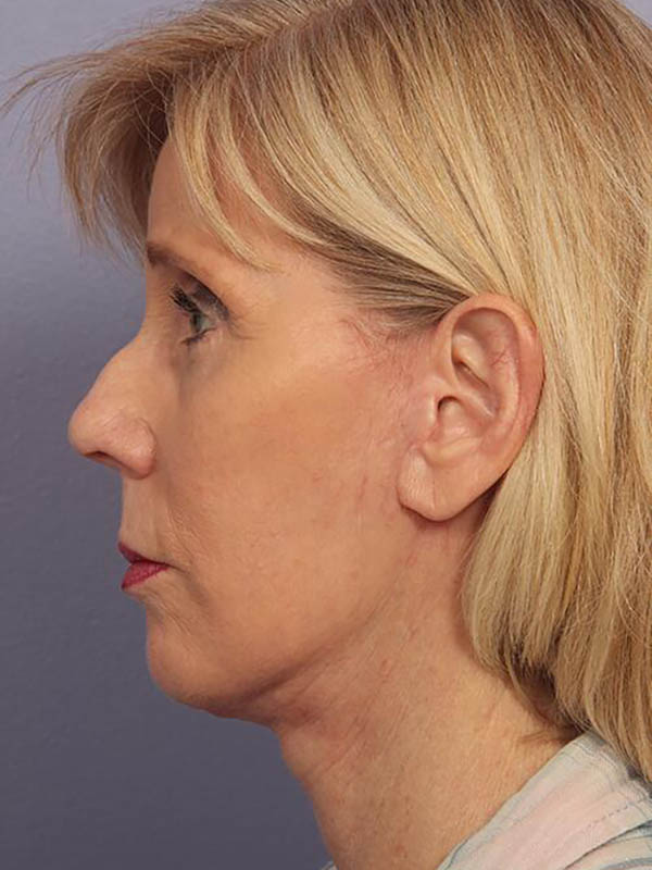 Facelift Before & After Image