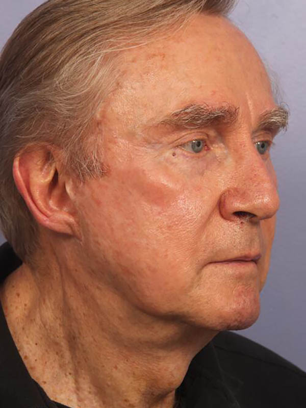 Facelift Before & After Image