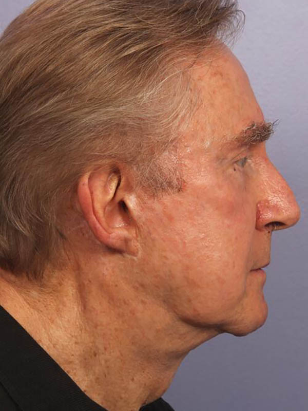 Facelift Before & After Image