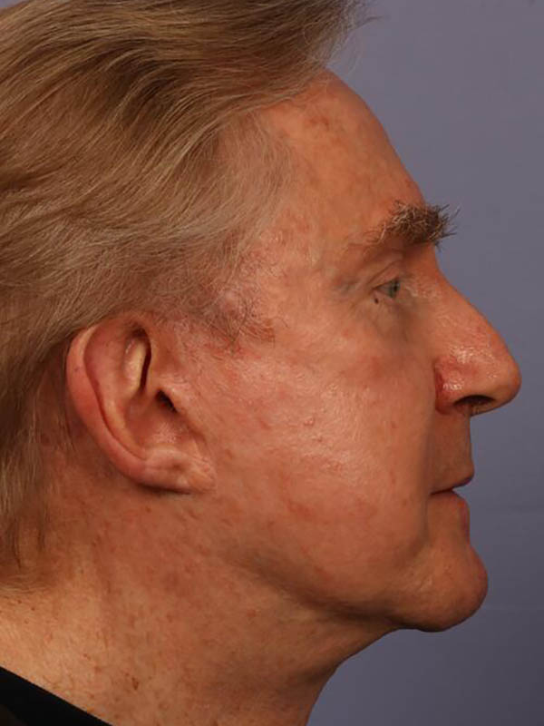 Facelift Before & After Image