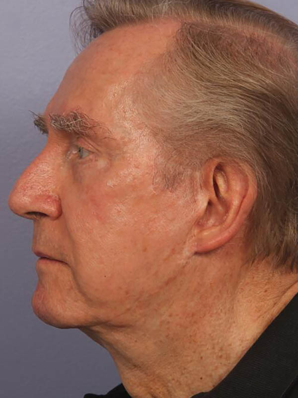 Facelift Before & After Image