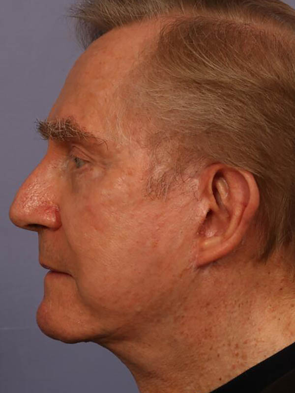 Facelift Before & After Image