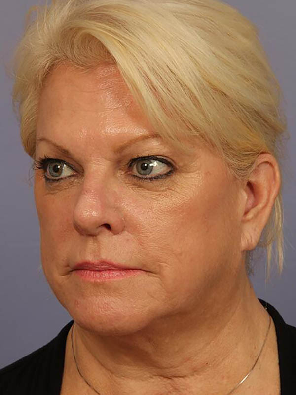 Facelift Before & After Image