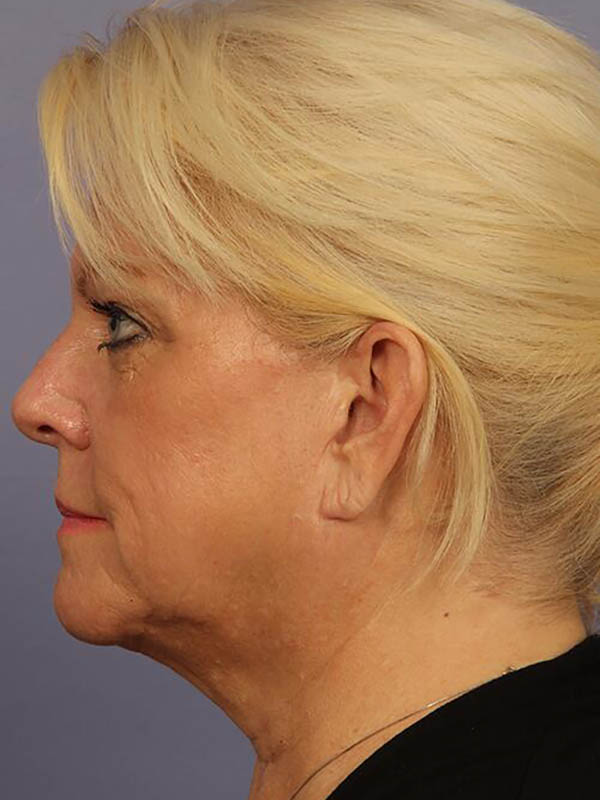 Facelift Before & After Image