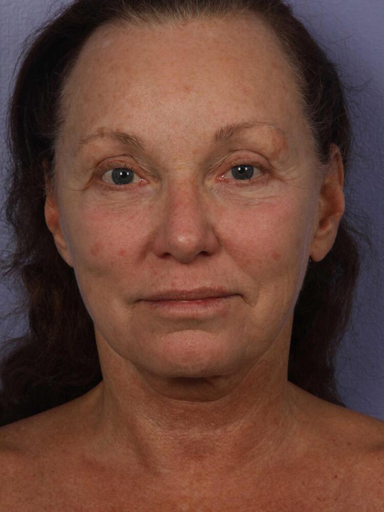 Facelift Before & After Image