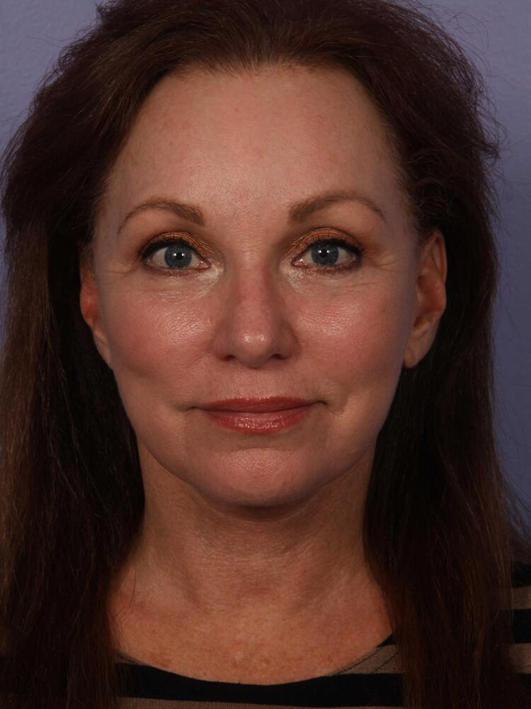 Facelift Before & After Image