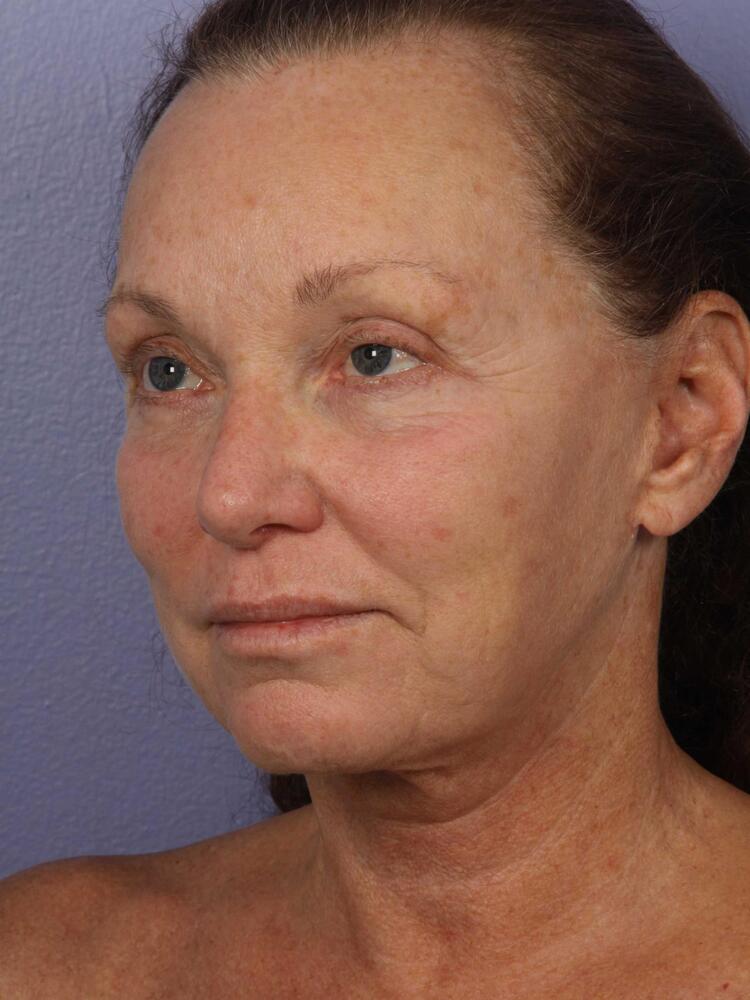 Facelift Before & After Image