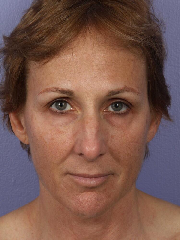 Facelift Before & After Image