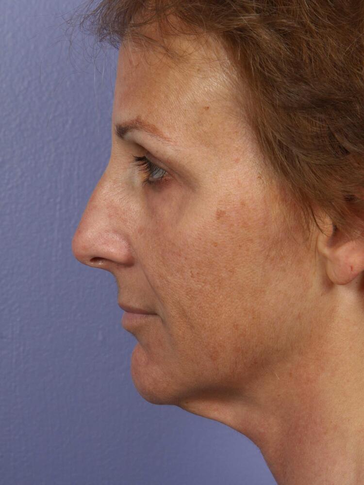 Facelift Before & After Image