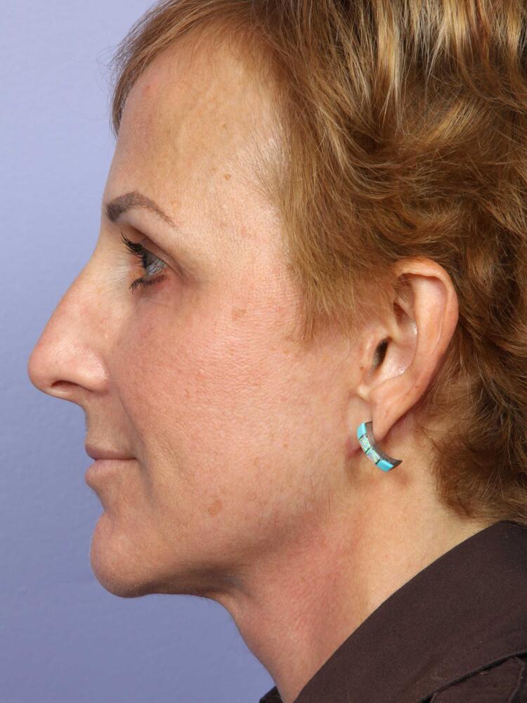 Facelift Before & After Image