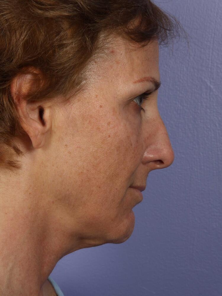 Facelift Before & After Image