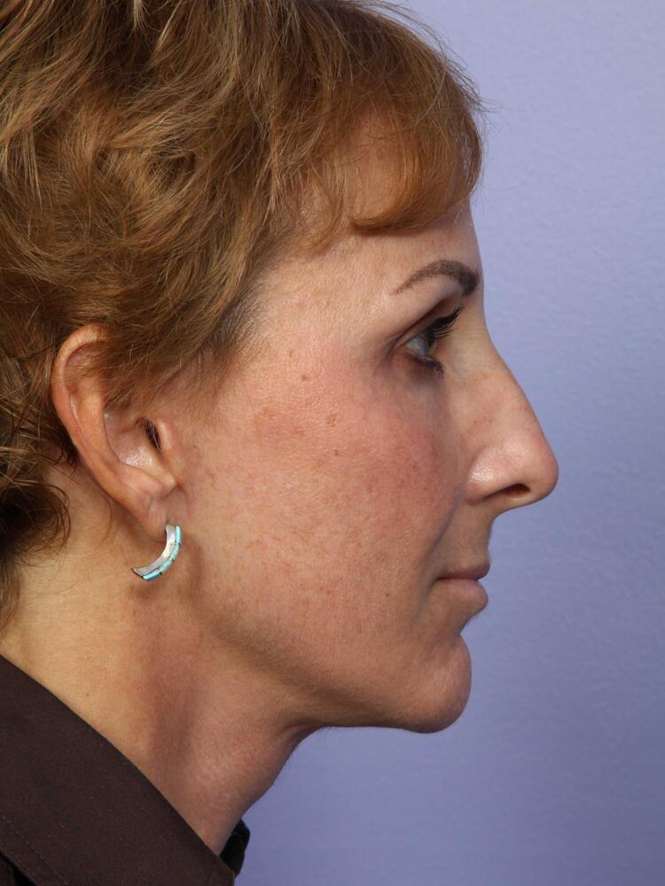 Facelift Before & After Image