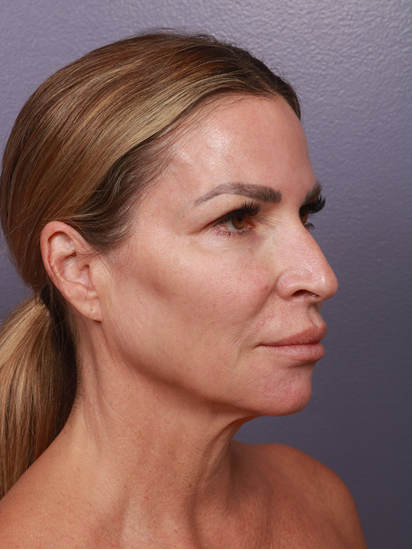 Facelift Before & After Image