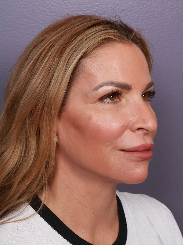 Facelift Before & After Image