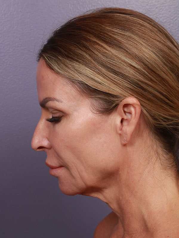 Facelift Before & After Image