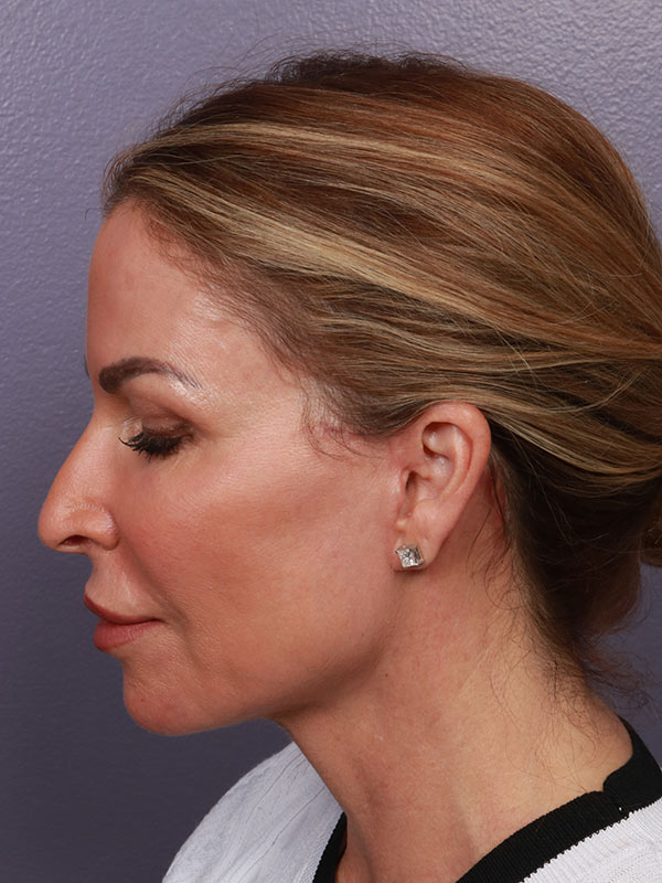 Facelift Before & After Image