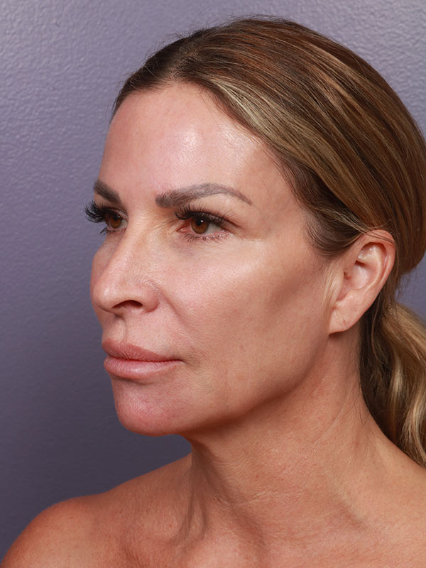 Facelift Before & After Image