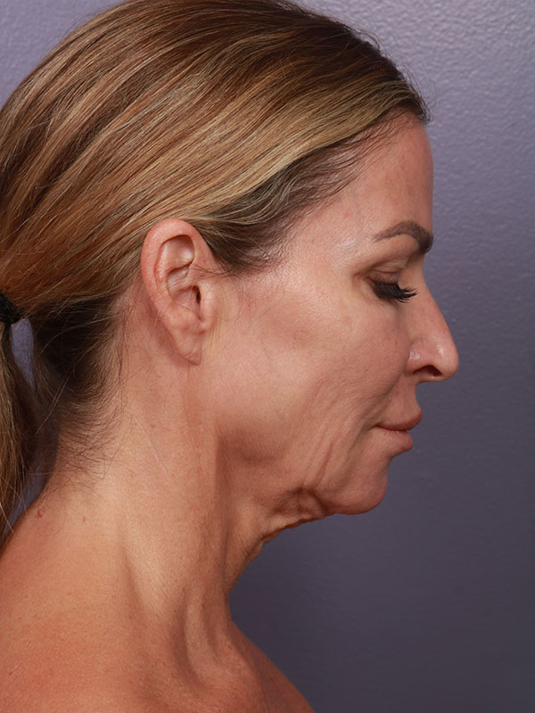 Facelift Before & After Image