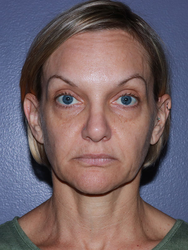 Facelift Before & After Image