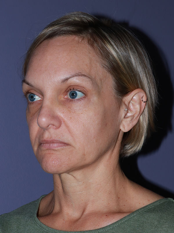 Facelift Before & After Image