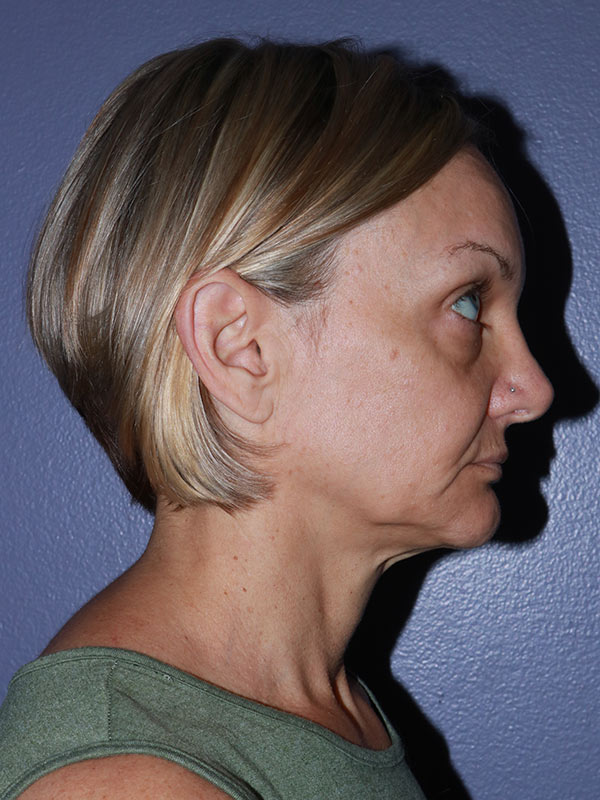 Facelift Before & After Image